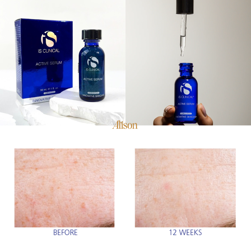 Serum Trị Mụn